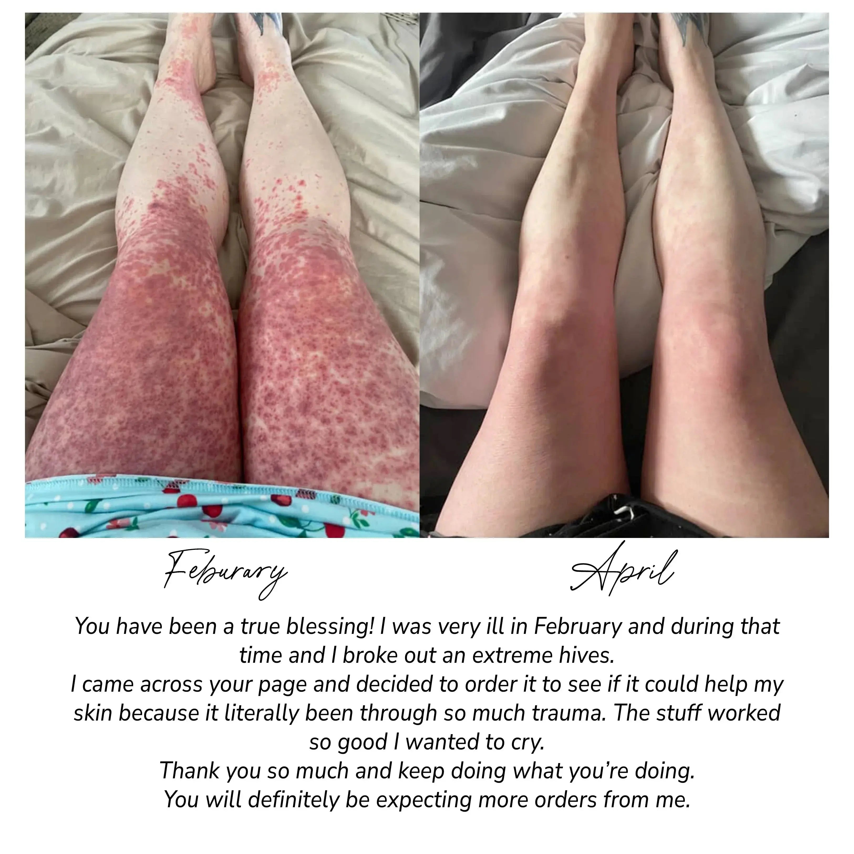 Before and after leg skin improvement, February to April, showing reduced redness and irritation
