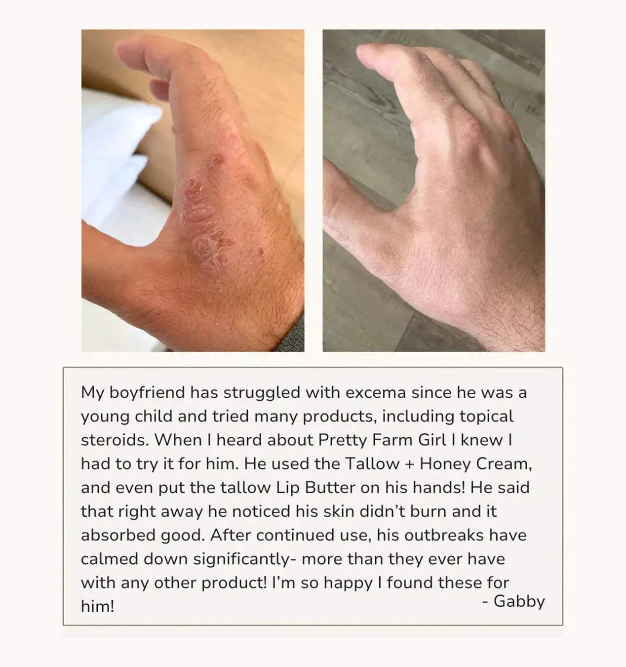 Before and after hand eczema relief using natural skincare cream, showing smooth, calm skin